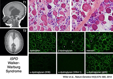 ISPD Walker-Wartburg Syndrome