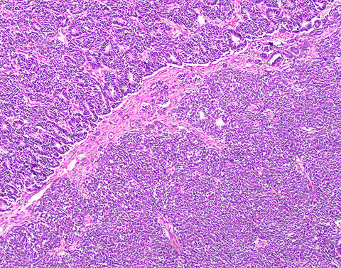 Wilms Tumor Wilms Tumor